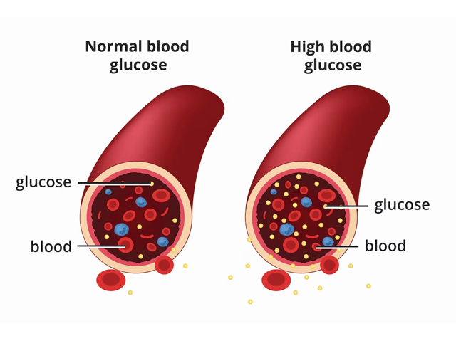 Diabetes Image