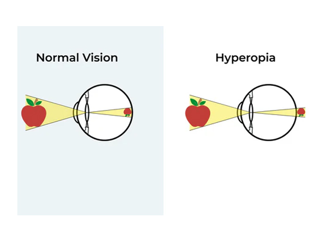 Hyperopia image