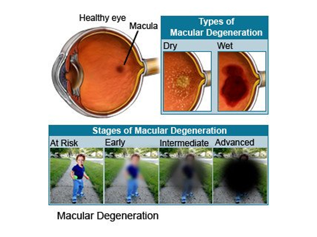 Macular Degeneration Image