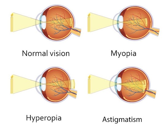 Myopia Image
