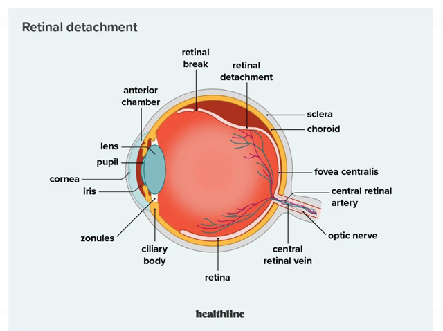Retinal Detachment Image