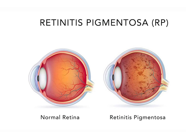 Retinitis Pigmentosa Image