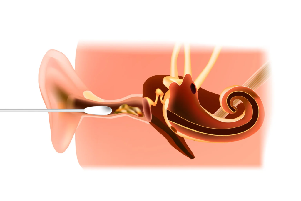 earwax img